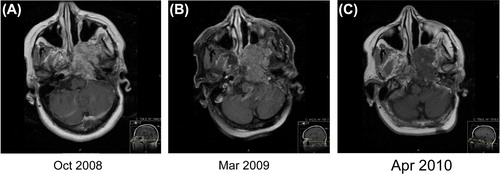 Figure 3. (A-C): Contrast enhanced T1 weighted MRI. (A) A contrast enhancing tumour with a size of 5×5×5 cm was observed in October 2008. (B) After treatment with cetuximab-erlotinib a clear decrease of contrast enhancement could be seen in March 2009. Due to toxicity cetuximab was stopped early, but treatment with erlotinib continued. (C) The contrast enhancement had decreased further in April 2010. The size of the tumour was unchanged.