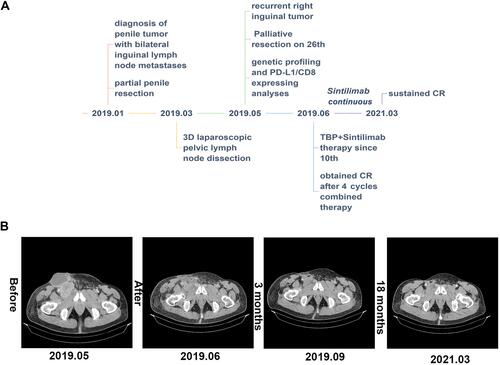 Figure 2 Clinical course and CT image of the case. (A) A scheme shows the time course of the patient in diagnosis and the therapy. (B) Enhanced CT images show the therapeutic response of the patient following a series of treatment.