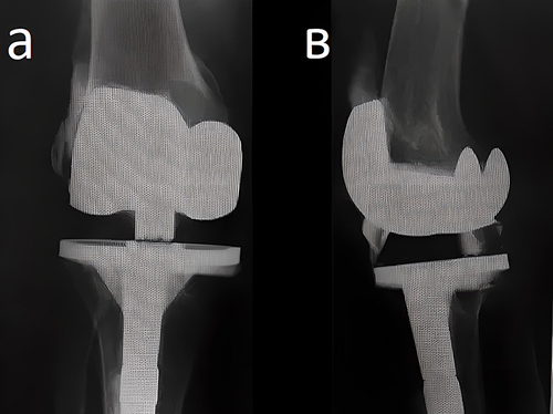 Figure 2 Radiography of the right knee joint before spacer implantation. Severe bone loss could be visible under tibial component. (a) in the frontal plane; (b) in the sagittal plane.