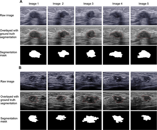 Figure 6 Results of u-net convolutional networks for multi-image-based US segmentation. (A) 69-year-old TNBC patient with BRCA+. The lesion is homogeneous. (B) A 52-year-old non-TNBC patient with BRCA+. The lesion is larger and heterogeneous.