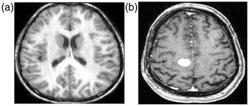 Figure 2. Sample MR images from the database, (a) normal image and (b) image with tumor.