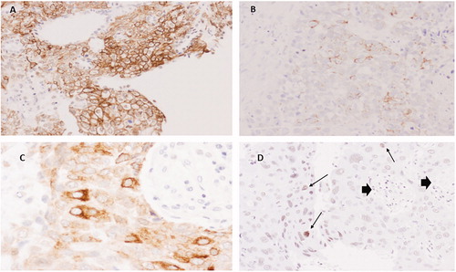 Figure 3. Immunohistochemistry for KRT15 in SCC. (A) Extensive positivity in well differentiated SCC in cell membranes (20×). (B) Poorly differentiated area with focal membranous staining (20×). (C) Area with predominant cytoplasmic staining (60×). (D) Poorly differentiated SCC showing some nuclei with faint staining (arrows). Note negativity in stromal cells (arrow heads) (20×).