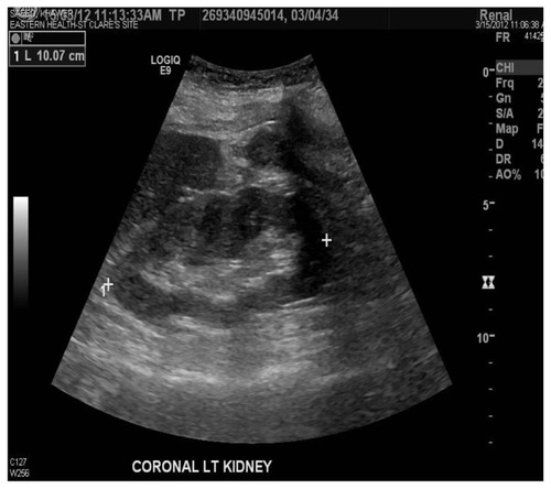 Figure 2 Kidney ultrasound revealed a left kidney measuring 10.1 cm.