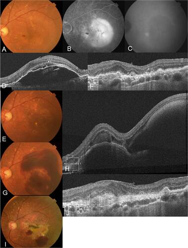 Figure 5 An 84-year-old man presented with metamorphopsia in his left eye. (A) A color fundus photograph of the left eye showing multiple soft drusen and preretinal hemorrhage with PED. (B) Late-phase fluorescein angiographic image of the fundus revealing pooling showing PED and hypofluorescence consistent with hemorrhage. (C) Hot spot consistent with neovascularization is clearly identified by indocyanine green angiography. (D) SD-OCT at baseline revealing elevated PED. The visual acuity was 20/25 in the left eye, and the patient was diagnosed as having RAP stage 2 with a PED. (E) After 15 ranibizumab injections were administered, at the 46-month follow-up, PED disappeared and visual acuity improved to 20/16. (F) SD-OCT showing an improvement in the PED. (G) However, 2 days after the 46-month check-up, massive subretinal hemorrhage developed and visual acuity declined to 20/200. (H) SD-OCT showing subretinal hemorrhage and hemorrhagic PED. (I) Finally, after an additional 30 ranibizumab injections, fibrosis with a partial small subretinal hemorrhage was observed at the 108-month follow-up. (J) SD-OCT showing fibrosis with loss of outer retina. Visual acuity decreased to 20/1000.