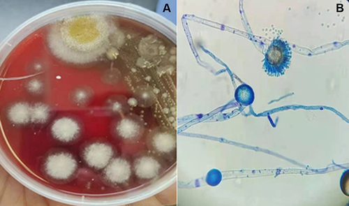 Figure 2 Macroscopic and microscopic features of Aspergillus flavus. (A) The BALF sample culturing on Columbia blood agar showed the yellow-green and cottony colonies. (B) Microscopic features including spiny conidiophores, radiant phialides on vesicles and biseriate phialides were observed under a light microscope using lactophenol cotton blue stain (LPCB, ×400).