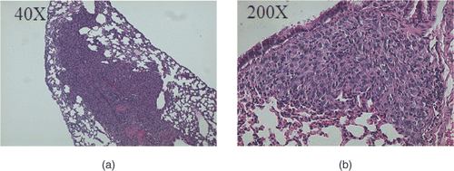 Figure 7. Lung metastases. Metastases were detected in the lungs from the mice in the control group. The metastases were seen as sheets of tumour cells replacing the normal lung architecture. (a) Lung metastasis at 40× magnification. (b) Lung metastasis at 200× magnification.