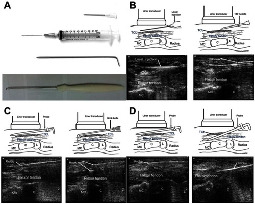 Figure 1 (A) Instruments for ultrasound-guided percutaneous carpal tunnel release: 18-gauge needle, 10 mL syringe with 21-gauge needle, custom-made blunt probe, custom-made hook knife. (B) Insertion of the 21-gauge needle for lidocaine infiltration and then to create an inlet with an 18-gauge needle. (C) The custom-made blunt probe was inserted subcutaneously to create the correct tract, and the hook knife was introduced to cut the TCL backwardly. (D) The probe was inserted to evaluate adequate release.