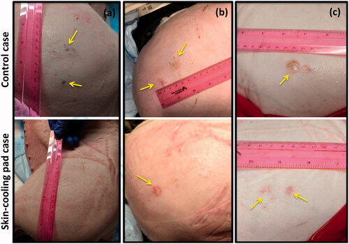 Figure 9. Gross assessment of the skin immediately post experiment. Any burns or other marks were noted for animals (a) 1, (b) 2 and (c) 3. The control condition side is shown in the top image with the skin-cooling condition shown in the bottom image. Burns or other marks are indicated with yellow arrows. The sonication matrices that resulted in burns or marks are indicated in Table 2.