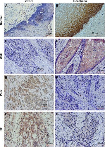 Figure 1 Representative images showing immunohistochemical staining for ZEB-1 and E-cadherin proteins in oral cavity squamous cell carcinoma (magnification ×200).