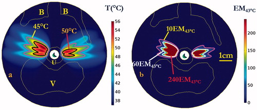 Figure 10. (a) Maximum temperature and (b) thermal dose of patient-specific Model II on the central axial plane after 600 s sonication. Temperature contours of 45 and 50 °C were shown in (a), and dose contours of 10 EM43 °C, 60 EM43 °C and 240 EM43 °C were shown in (b). Note due to patient positioning and anatomy, pelvic bone is delineated on one side only in this plane. (B denotes pubic bone, V denotes vagina, and U denotes urethral mucosa and surrounding layers of connective tissue. The display of thermal dose was set at a maximum threshold of 240 EM43°C for visualization purposes).