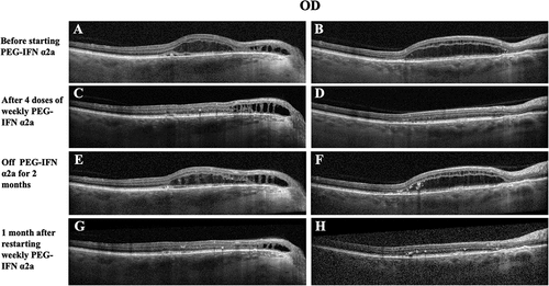 Figure 9. Serial macular OCT of the right eye obtained during the treatment course of Patient 2. The same cuts of representative OCT images in the right eye from various time points were used for comparison. A-B. Persistent multifocal SRF and IRF despite multiple sessions of PDTs and various empiric treatments of CSCR, and immunomodulatory therapies, before starting PEG-IFN α2a monotherapy. C-D. Significant rapid improvement on SRF/IRF after 4 doses of weekly PEG-IFN α2a monotherapy. E-F. Rapid recurrence of SRF/IRF after the patient was off PEG-IFN α2a monotherapy. G-H. Near resolution of SRF/IRF after restarting PEG-IFN α2a monotherapy.