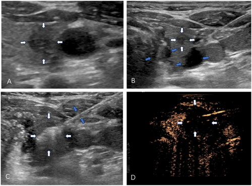 Figure 1. Images of a 52-year-old woman with papillary thyroid carcinoma in the right lobe treated with microwave ablation. (A) Ultrasound showed a hypoechoic tumor in the right lobe (white arrows). (B) The hydro dissection technique (blue arrows) was used to keep the thyroid lobe far from the carotid artery, trachea, and nerves to guarantee the safety of ablation. (C) The microwave ablation antenna was precisely inserted into the tumor (blue arrows) and the ablation zone showed a hyperechoic pattern in the tumor around the antenna tip (white arrows). (D) Postablation CE-US image showed no enhancement in the tumor (white arrows).