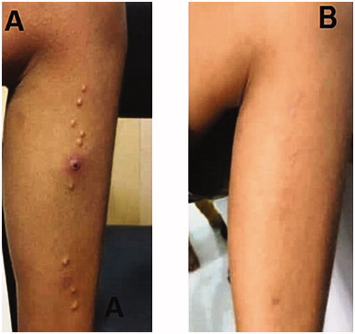 Figure 1. A case of MC showing complete response after topical Cantharidin .7% for eight week.