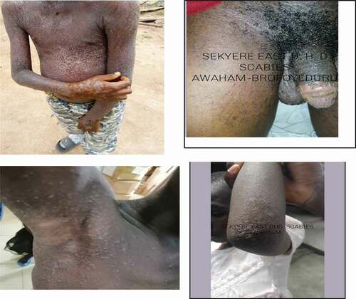 Figure 5. Manifestation of scabies infections