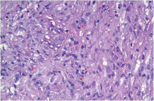 Figure 4. Lymph node biopsy: (hematoxylin and eosin stain) lymphohistiocytic infiltrate (red arrows).