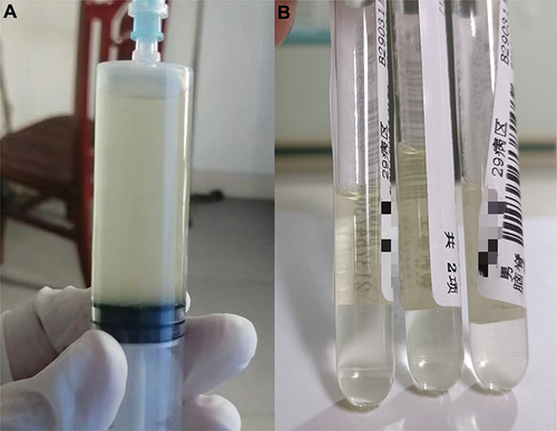 Figure 3 Changes in cerebrospinal fluid (CSF) in patient with intracranial A. baumannii infection before and after treatment. (A) CSF on May 19; (B) CSF on May 28.