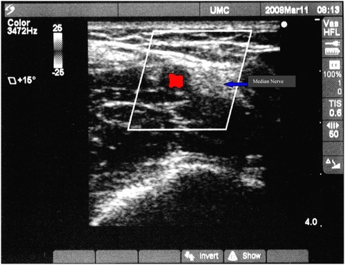 Figure 3 Ultrasound view of brachial artery with median nerve to reader’s right.