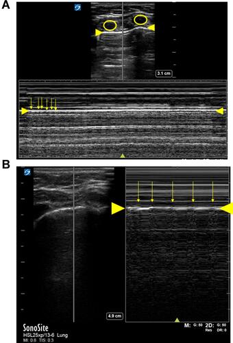 Figure 4 Bar code sign in an infant (A) and in a child (B). The ribs are the echoic areas within the yellow circles. The pleural line is noted by the larger yellow arrow. There are numerous artifacts in the bar code sign (small yellow arrows).