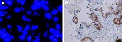 Figure 3 LOC101927967-ALK fusion in the patient with lung adenocarcinoma. (A) A split signal of ALK was observed with a frequency of 66% in the fluorescence in situ hybridization image. (B) The immunohistochemistry staining indicated strong positive ALK protein expression.