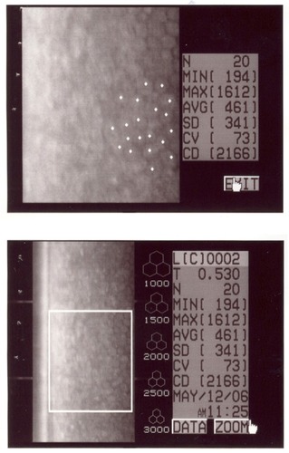 Figure 11 Specular microscopy in OS.