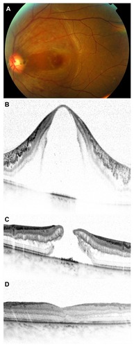 Figure 1 Case 3. Preoperative fundus photograph showing a temporally located optic disc pit with associated maculopathy (A). Spectral-domain optical coherent tomography (Spectralis, Heidelberg Engineering, Heidelberg, Germany) images through the macula obtained before (B), 2 months after (C), and 3 months after (D) first vitrectomy.