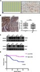 Figure 1 HDAC6 was overexpressed in colon cancer tissues and associated with poor prognosis. (A) Human CRC tissues were detected by Super Chips microarrays. (B) The tumor sections underwent IHC staining using antibodies against HDAC6. (C) HDAC6 expression in 8 cases of human CRC tissues and their matched adjacent normal tissues by western blot analysis. (D) Kaplan-Meier survival analysis by HDAC6 status (n=83). The vertical axis represents the percentage survival rate; the horizontal axis represents the survival days. The blue line indicates that the patients with higher HDAC6 expression had a worse overall survival than the red line. The overall median survival (OS) time was 55 months for the HDAC6-positive group and 58 months for the HDAC6-negative group. The data shown represent mean ± SD from a representative experiment.Note: *P<0.05.