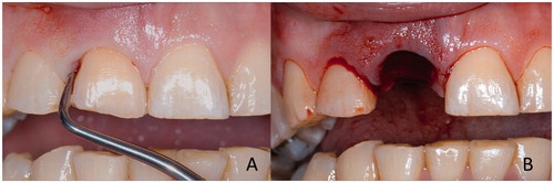Figure 1. Use of natural tooth as pontic of FRC FPD. Severely periodontally damaged tooth (A) needs to be extracted (B) and replaced by minimally invasive FPD immediately after extraction.