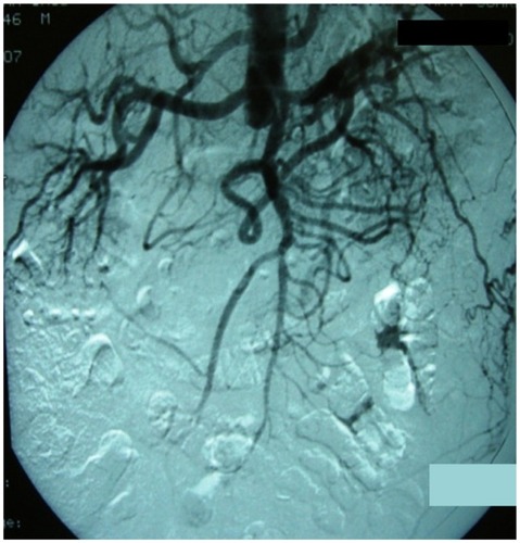 Figure 1 Angiogram of the case 1 patient showing complete occlusion of infrarenal aorta.