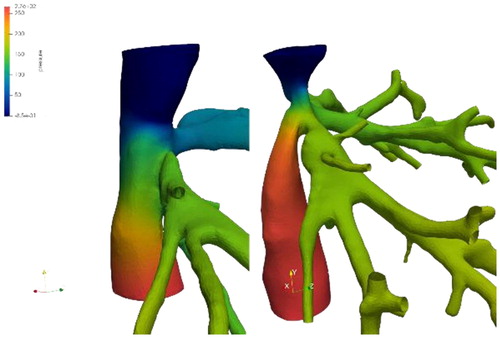 Figure 2. Pressure in side- by side (left) and termino- lateral (right) on 2 real patients.