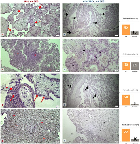 Figure 2. EGFR and IL-8 expression on trophoblastic and decidual tissue specimens among the RPL and elective abortion (control) group. (A) Moderate expression of EGFR on RPL trophoblastic tissue (↑) (×10 magnification). (B) Mild expression of EGFR on control trophoblastic tissue (↑) (×4 magnification). (C) Mild expression of EGFR on RPL decidual tissue (*) (×4 magnification). (D) Mild expression of EGFR on control decidual tissue (*) (×10 magnification). (E) Moderate expression of IL-8 on RPL trophoblastic tissue (↑) (×40 magnification). (F) Mild expression of IL-8 on control trophoblastic tissue (↑) (×4 magnification). (G) Moderate to strong expression of IL-8 on RPL decidual tissue (*) (×10 magnification). (H) Mild expression of IL-8 on control decidual tissue (*) (×4 magnification). The graphs are an approximate percentage of staining for the specimens presented in this figure.