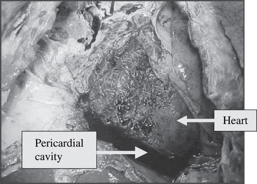 Figure 1. Hemorrhagic pericardial effusion.