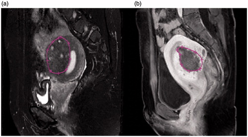 Figure 4. Measurement of volume of adenomyotic lesions and the non-perfused volume (NPV). (a) Measurement of the volume of adenomyotic lesion. (b) Non-perfused volume (NPV).
