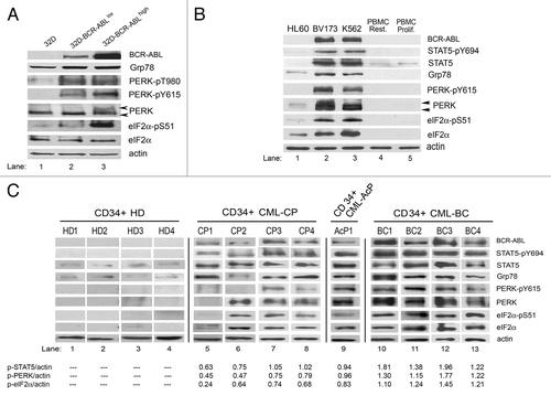 Figure 1. The PERK-eIF2α phosphorylation pathway is upregulated in mouse and human cell lines expressing BCR-ABL and in CD34+ CML cells. (A) Expression of BCR-ABL, Grp78, PERK, PERK-pY615, PERK-pT980, eIF2α and eIF2α-pS51 in mouse progenitor 32D cells and 32D cells expressing different levels of BCR-ABL. (B) Expression of BCR-ABL, STAT5, STAT5-pY694, Grp78, PERK, PERK-pY615, eIF2α and eIF2α-pS51 in HL60, BV173 and K562 cells or resting and proliferating PBMC from healthy donors. Arrows indicate the lower—unphosphorylated and the higher—hyperphosphorylated PERK. (C) Expression of BCR-ABL, STAT5, STAT5-pY694, Grp78, PERK, PERK-pY615, eIF2α and eIF2α-pS51 proteins in progenitor CD34+ cells isolated from the whole blood of healthy donors (CD34+ HD, lanes 1–4), CML-chronic phase (CD34+ CML-CP, lanes 5–8), CML-accelerated phase (CD34+ CML-AcP, lane 9) or CML-blast crisis patients (CD34+ CML-BC, lanes 10–13). The ratio of phosphorylated STAT5, PERK and eIF2α proteins to actin was calculated based on the densitometry using GeneTools from Syngene.