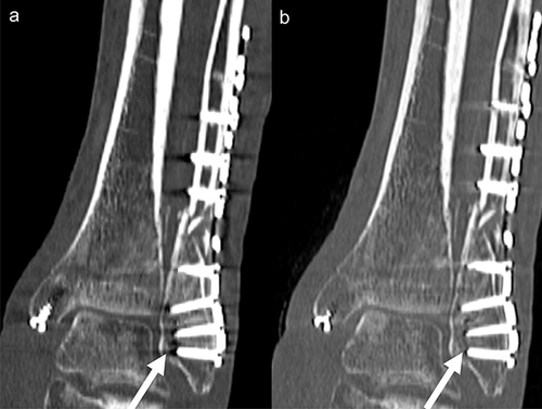 Figure 4 Projection-based MAR in a patient with open reduction and internal fixation of a trimalleolar ankle fracture. Arrow: exemplary absorption artifact caused by the implant. (a) Standard CT reconstruction. (b) Projection-based MAR with Improved metal artifact reduction as compared to standard CT reconstruction. Arrow: exemplary absorption artifact caused by the implant; the artifact is reduced in projection-based MAR reconstruction images as compared to standard CT reconstruction images.