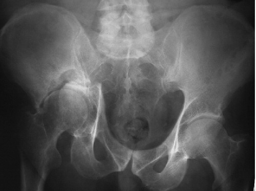 Figure 1. Preoperatively, advanced metastatic destruction of the right acetabulum with a pathological fracture and medial and cranial dislocation of the acetabulum.