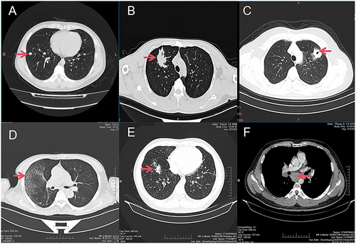 Figure 1 Imaging manifestations in the case group, indicated with arrows, including the nodule image (A), mass image (B), cavity image (C), interstitial change (D), patchy image (E), and enlargement of mediastinal lymph nodes (F).