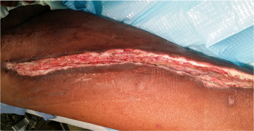 Figure 3 Wound after VAC dressing.
