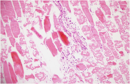 Figure 5 Prominent damage pattern is seen in most of the muscle fibers. There are also inflammatory cell infiltration sites between muscle fibers and significant congestion in veins (HE, 20x).
