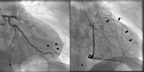 Figure 1 A) Right anterior oblique caudal view of left anterior descending artery. Total proximal occlusion of left anterior descending artery (white arrow). Arrowheads indicate mild ipsilateral collaterals from the obtuse marginal to the left anterior descending artery. B) Straight right anterior oblique view of right coronary artery. Contralateral collaterals from the right coronary artery are feeding the distal part of the left anterior descending artery (white arrow), giving the impression of a narrow and multi-atheromatous vessel. Arrowheads show severe and diffuse atheroma in the left anterior descending artery. (Image courtesy of the Catheterization Laboratory at Patras University Hospital).
