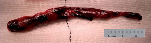 Figure 2. Embolic clot removed from the left pulmonary artery. Photo: The author.