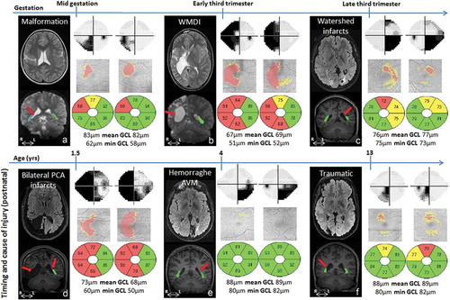 Figure 1. Brain injury on MRI, visual field defects and GCL+IPL topography and layer thickness presentation for cases A-F. GW = gestational week, yrs = years, WMDI = white matter damage of immaturity, PCA = posterior cerebral artery, AVM = arteriovenous malformation, OR = optic radiation. Cases A to F are presented according to the timing of the damage (see Table 1). For each case the brain injury is presented on representative conventional MRI (first panel, top row), the reconstructed ORs are super-imposed on conventional MRI (first panel, bottom row) with red arrows indicating the location of injury (see Table 1 for descriptive analysis). Visual fields are presented in grey scales, with black indicating visual field defects. Below the GCL+IPL topography, with red indicating thinning, the thickness values for each macular area are presented. Green colour indicates values within the normal range, yellow borderline and red thin. Mean GCL+IPL values and minimum values for each eye are given in microns. There was a correlation between the sectors with GCP+IPL thinning (indicated by red and yellow in the grey fundus photos) and the visual field defects (indicated with dark/black colour in the greyscale map) in all except one case (E). However, in that case, there was an abnormal asymmetry in GCL+IPL thickness between the sectors, with a correlation between the thinnest sectors and the visual field damage.