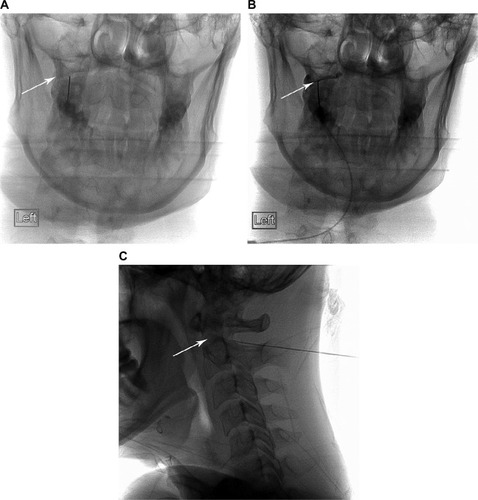 Figure 2 Needle position and contrast filling of the C1–2 joint.