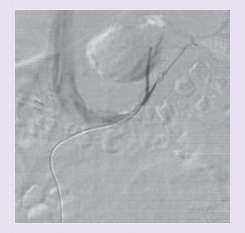 Figure 1. Left adrenal vein.