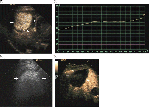 Figure 1. Microwave ablation images in an 80-year-old man who had HCC. (A) The contrast-enhanced US arterial phase pre-ablation image shows a 5.8 × 5.0 cm HCC (arrow). (B) The US image shows the hyperechoic region syncretized and covered the target region (arrow). (C) The curve of temperature monitoring during microwave ablation shows that the temperature measured of the tumour periphery is over 60° (yellow curve). (D) The contrast-enhanced US arterial phase image post-ablation 2 days shows a 6.9 × 6.1 cm non-enhancing zone enveloping the tumour (arrows).