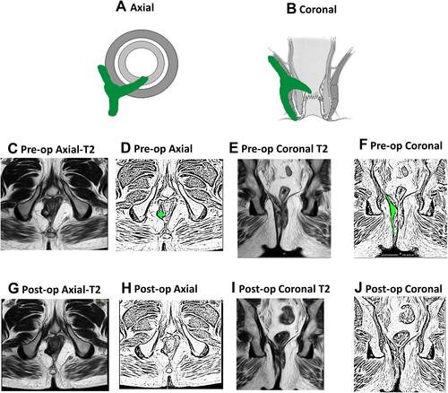 Figure 2 A 45-year-old male patient with a right-sided high transsphincteric fistula. MRI done 12 weeks after surgery showed complete healing. He had a weighted score of zero as per the new scoring system (NSS). The patient is asymptomatic at follow-up of 38 months. (A) Axial section (schematic diagram); (B) coronal section (schematic diagram); (C) pre-operative axial T2-weighted MRI showing high tract at 7 o’clock; (D) sketch of figure (C) highlighting high tract at 7 o’clock (green color); (E) pre-operative coronal T2 weighted MRI showing high tract of right side; (F) sketch of figure-(E) highlighting high transsphincteric tract on right side (green color); (G) post-operative axial T2-weighted MRI showing healed fistula at 3 months; (H) sketch of figure-(G); (I) post-operative coronal T2-weighted MRI showing healed fistula; (J) sketch of figure-(I).