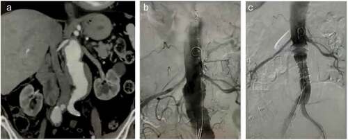 Figure 1. (a) A 55 mm abdominal aortic aneurysm with short neck (average diameters of 27.6 mm and 32.7 mm at 7 mm at 10 mm diameter below the lowermost renal artery, respectively). (b). Efficient sealing relies on the accurate apposition of the first sealing ring immediately below the renal arteries. (c). Intraoperative completion angiography demonstrating technical success, i.e. aneurysm exclusion without endoleak (image courtesy of Dr. Kapoulas).