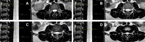 Figure 3 (A) demonstrates a parasagittal mid pedicular cut at the top of the vertebral body; axial cut image of the pedicle is seen on the right. Note the lack of a neural foramen at this level. (B) illustrates a parasagittal image directly below the pedicle (left) and a patent neural foramen (NF) on the right image. (C) (left) is a mid foraminal cut which defines the exiting spinal nerve (N) on the axial image to the right. (D) (bottom right) is a slice taken below the spinal nerve and just above the pedicle. Notice how the NF is narrow here compared to 3B or 3C.