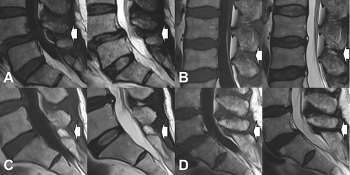 Figure 2 The components of the posterior ligament complex (white arrow) were classified into a 4-grade category according to the modified Fujiwara’s criteria described by Kong. (A). Type 1 (low intensity on both T1- and T2-weighted images without hypertrophy of the spinous process); (B). Type 2 (low intensity on T1-weighted and high intensity on T2-weighted images); (C). Type 3 (high intensity on T1- and intermediate to high intensity on T2-weighted images); (D). Type 4 (low intensity on both T1- and T2-weighted images with hypertrophy of the spinous process, mixed signal or same signal pattern).