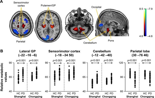 Figure 2 Brain regions with overlapping abnormal metabolism in PD patients relative to normal subjects detected by conjunction analysis of 18F-FDG PET scans with SPM across Chongqing and Shanghai cohorts. (A) Metabolism in PD patients was increased (red) in the putamen, GP, thalamus, pons, sensorimotor cortex and cerebellum, but decreased (blue) in parieto-occipital areas. The thresholds of the color bars represent T values. (B) Group differences in relative metabolic values in select cortical and subcortical regions, obtained post hoc in spherical volumes of interest (4 mm radius) centered at the peak of clusters deemed significant from prior SPM analysis on a voxel-by-voxel basis. Error bars represent mean±SD.
