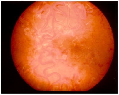 Figure 1 Color fundus picture of the left eye at presentation showing the retinal racemose angioma. The optic disc is obscured by vessels. The retinal vessels in the macular area are white indicating ischemia. Findings remained stable over the 8 year follow-up period.